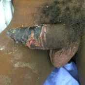 52%20%20Gangrene%20%28a%29.jpg