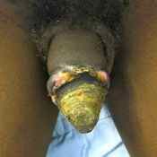 52%20%20Gangrene%20%28b%29.jpg