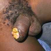 52%20%20Gangrene%20%28d%29.jpg
