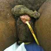 55%20%20Gangrene%20%28b%29.jpg