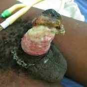 63%20%20Gangrene%20%28a%29.jpg