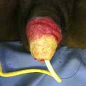 63%20%20Gangrene%20%28c%29.jpg