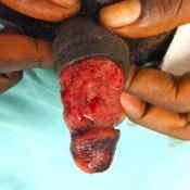 76%20%20Large%20wound.jpg