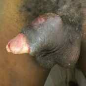 90%20%20Abscess.jpg