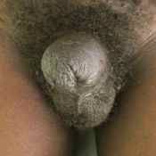 94%20%20Gangrene%20%28c%29.jpg