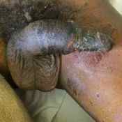 97%20%20Gangrene%20%28a%29.jpg