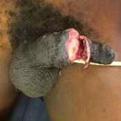 97%20%20Gangrene%20%28b%29.jpg
