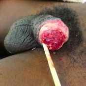 97%20%20Gangrene%20%28d%29.jpg