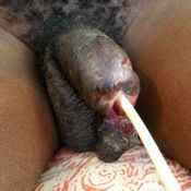 101%20%20Gangrene%20%28a%29.jpg