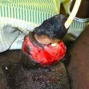 105%20%20Gangrene%20%28a%29.jpg
