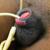 105%20%20Gangrene%20%28c%29.jpg