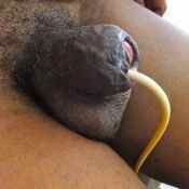105%20%20Gangrene%20%28d%29.jpg