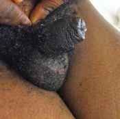 108%20%20Gangrene%20%28c%29.jpg