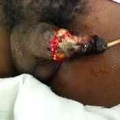 112%20%20Gangrene%20%28a%29.jpg