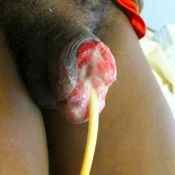 112%20%20Gangrene%20%28c%29.jpg
