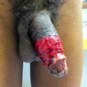 113%20%20Large%20wound.jpg