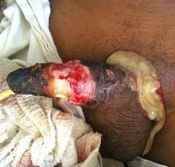 122%20%20Gangrene%20%28a%29.jpg