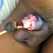 122%20%20Gangrene%20%28b%29.jpg