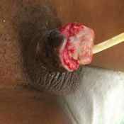 122%20%20Gangrene%20%28d%29.jpg