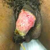 143%20%20Gangrene%20%28a%29.jpg