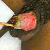 143%20%20Gangrene%20%28b%29.jpg