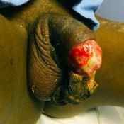 153%20%20Gangrene%20%28a%29.jpg