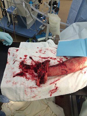 hand-destroyed-4th-july.jpg