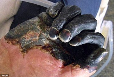 bubonic-plague-hand.jpg