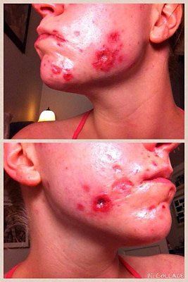 facial-staph.jpg