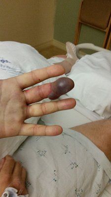 rattlesnake-bite-hand-001.jpg