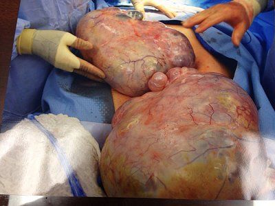 ovary-removed.jpg