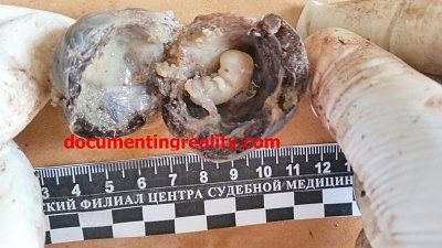 ectopic-pregnancy1.jpg