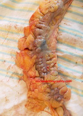 diverticulosis1.jpg