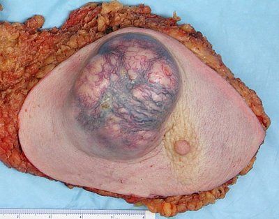 breast-20cancer-20-5bnsfl-5d-20-5bgore-5d-20-20imgur.jpg