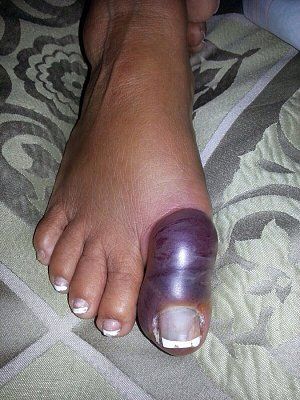 stubbed-toe.jpg
