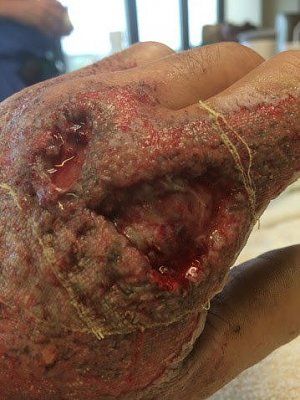 sandblaster-injury.jpg