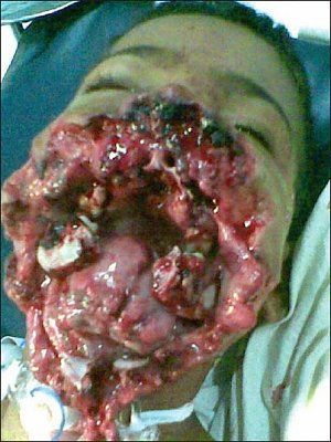 01-20blast-20injury-20face-20-20preoperative-20photo.jpg