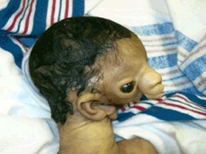 Name:  Treacher_Collins_Syndrome_side_view_300x225.jpg
Views: 54356
Size:  18.9 KB