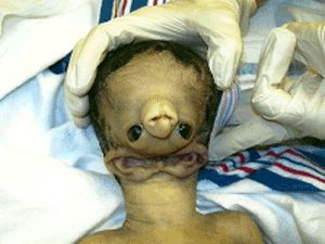 Name:  Treacher_Collins_Syndrome_300x225.jpg
Views: 45458
Size:  18.5 KB