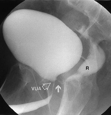 vesicointestinal-fistula.jpg