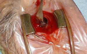 Name:  evis5-The%20uveal%20content%20is%20removed%20with%20a%20evisceration%20spoon..jpg
Views: 727
Size:  25.1 KB