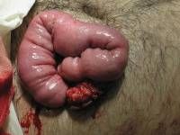 penetrating%20jejunal%20injury%20to%20evisceration.jpg