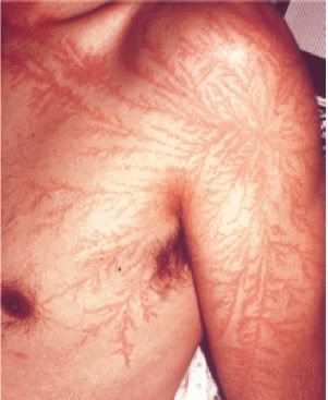 lichtenberg-figure-in-skin.jpg