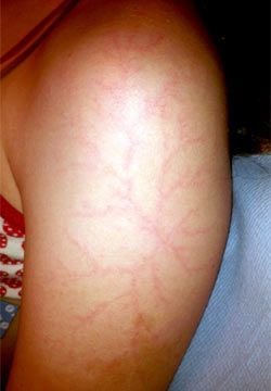 erin-moran-s-injury-from-the-lightning-strike-418677829.jpg
