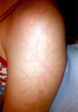 erin-moran-s-injury-from-the-lightning-strike-418677829.jpg