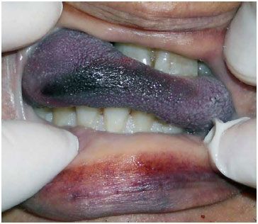 Name:  typical%20hanging%20death%20-%20tongue%20protrusion.jpg
Views: 447
Size:  28.1 KB