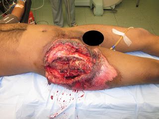 Name:  soft%20tissue%20loss%20-%20gross%20contamination.JPG
Views: 377
Size:  28.0 KB