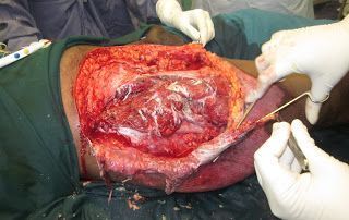 Name:  2-%20surgical%20debridement%20in%20progress.JPG
Views: 422
Size:  29.6 KB