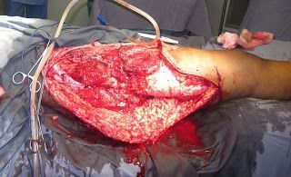 Name:  2nd%20debridement%20-%20extensive%20in%20nature.JPG
Views: 381
Size:  33.6 KB