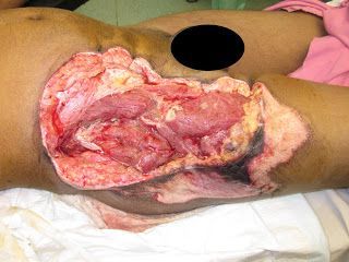 Name:  skin%20necrosis%20plus%20infection%20with%20gas%20forming%20organism.JPG
Views: 377
Size:  32.0 KB